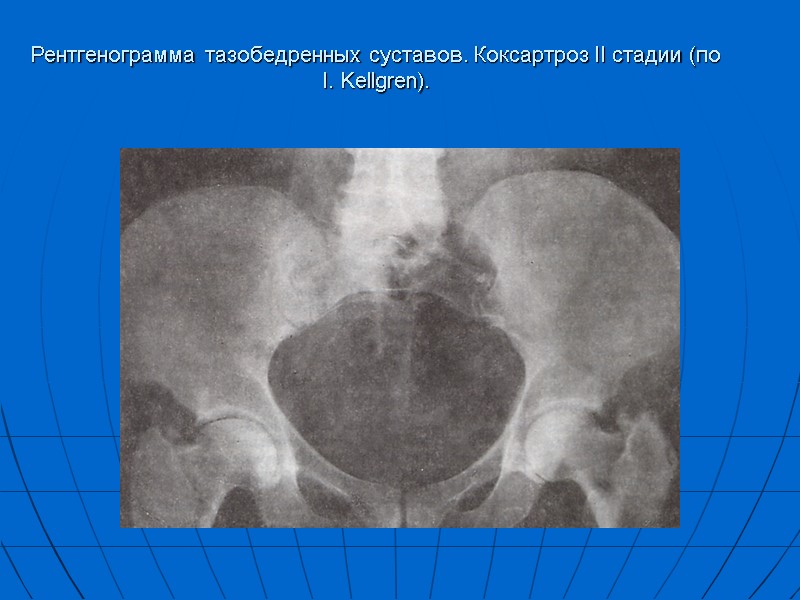 Рентгенограмма тазобедренных суставов. Коксартроз II стадии (по I. Kellgren).